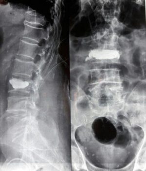 Kyphoplasty and Vertebroplasty