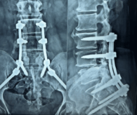 Spine Implant Surgery