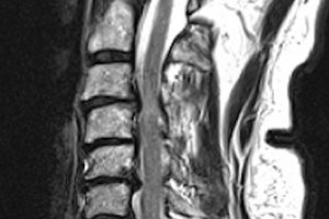 Best cervical spondylosis treatment in Mumbai