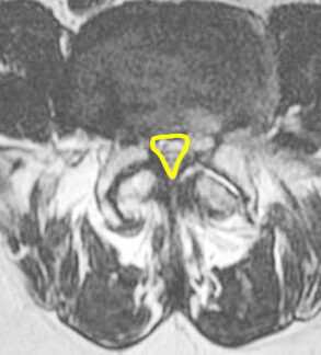 spinal stenosis treatment in Mumbai