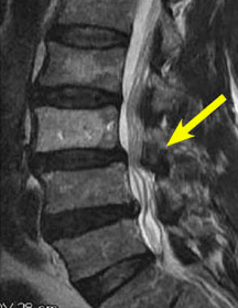 Best lumbar spondylosis treatment in Mumbai