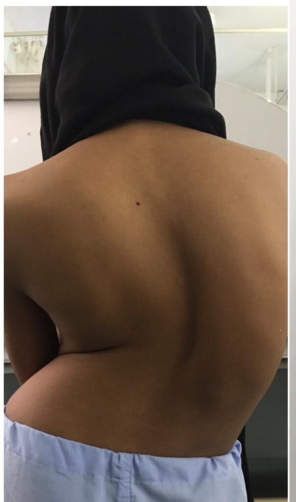 Best scoliosis treatment in India