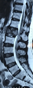 Best spinal tumor treatment in Mumbai