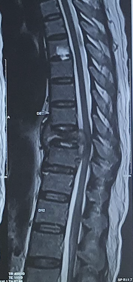 Best spinal tuberculosis treatment in India