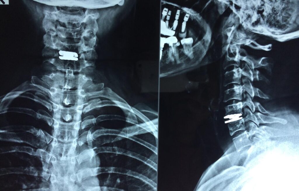 Cervical disc replacement surgery