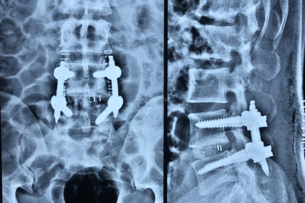 spine instrumentation surgery