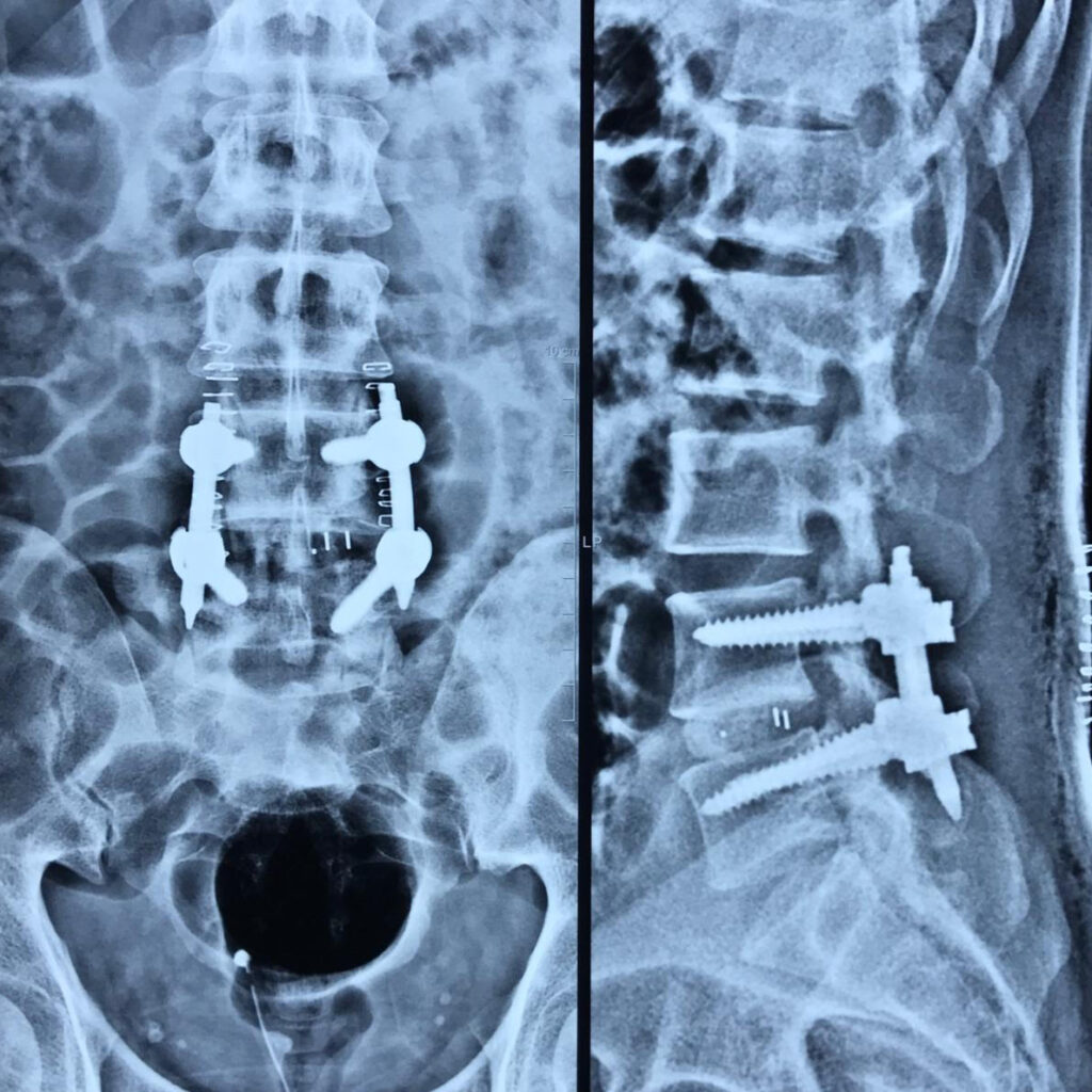 spine instrumentation surgery