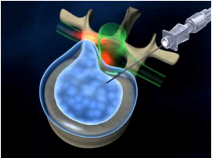 Best laser spine surgeon in Mumbai
