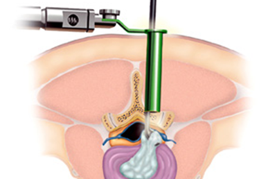 Minimally invasive spine surgery