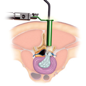 Minimally invasive spine surgery