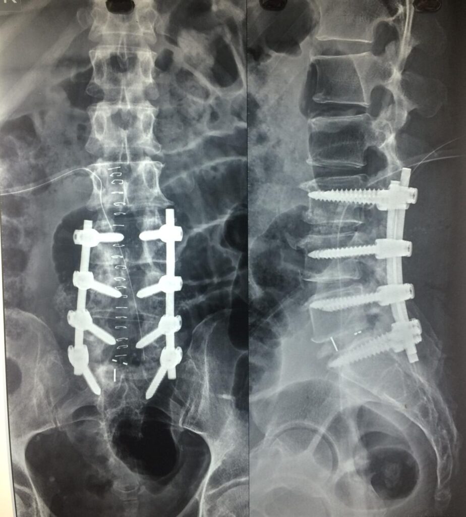 Spinal fusion surgery