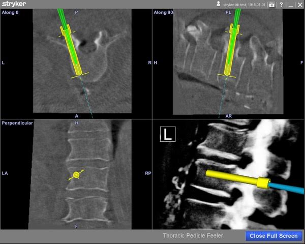 Computer navigation in Spine Surgery