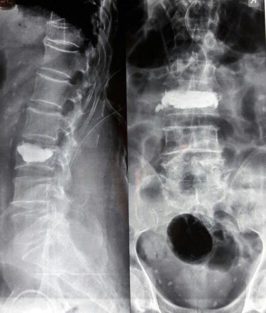 Kyphoplasty surgery in Mumbai