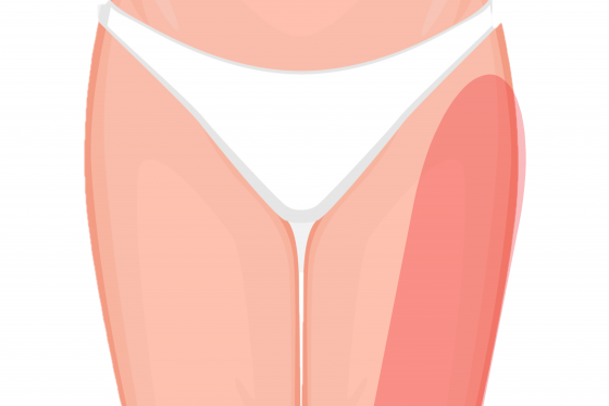 Meralgia Paresthetica