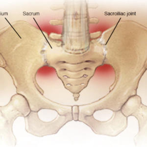 Sacroiliitis