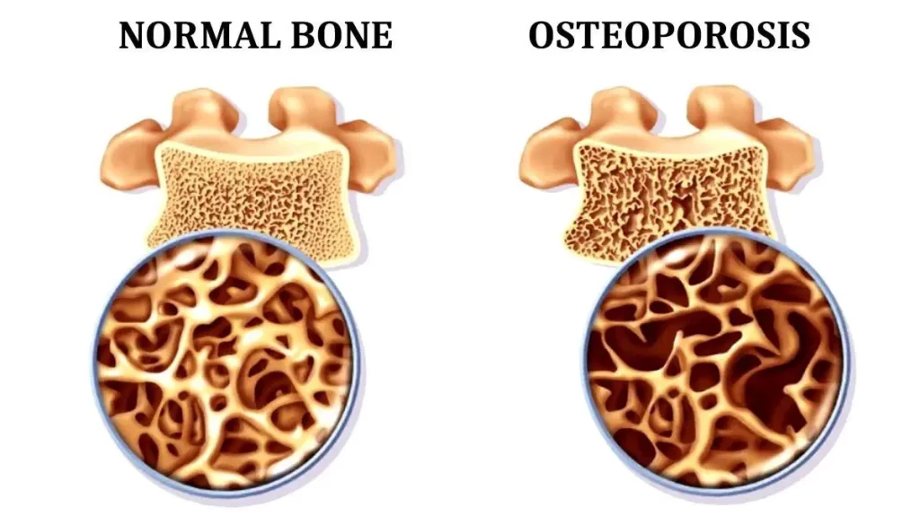 Spine Osteoporosis