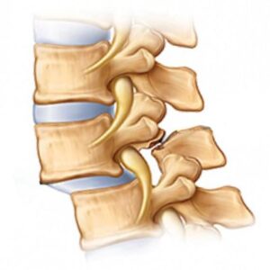Spondylosis vs Spondylolysis vs Spondylolisthesis