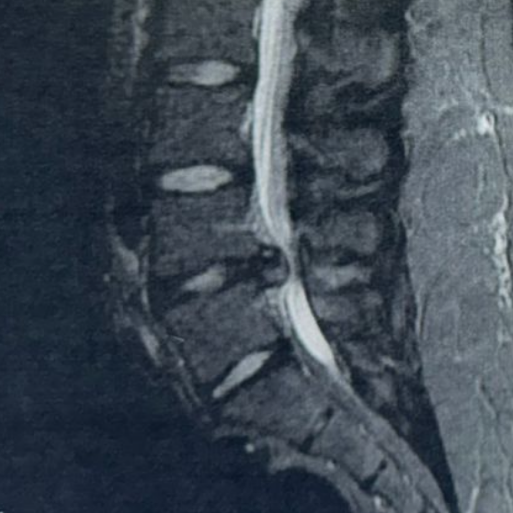 L4-5 disc prollapse