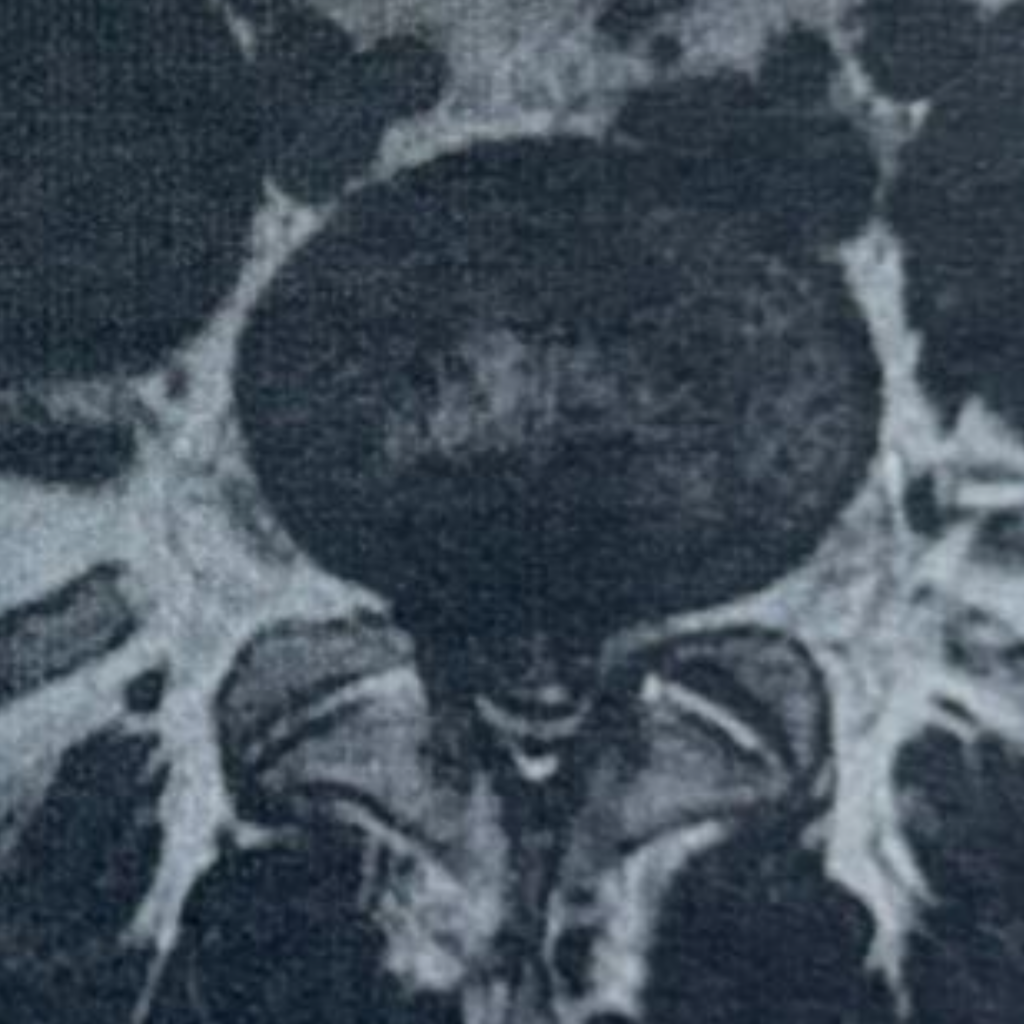 Axial cut of MRI showing L4-5 disc prolapse