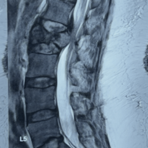 MRI showing L2 fracture with spinal cord compression