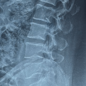 X-ray showing normal bone anatomy