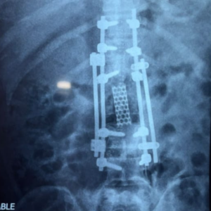 Post-op x-ray showing spinal reconstruction